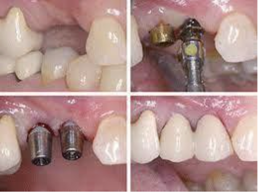 Dental Implants Treatment in Vasanth Nagar